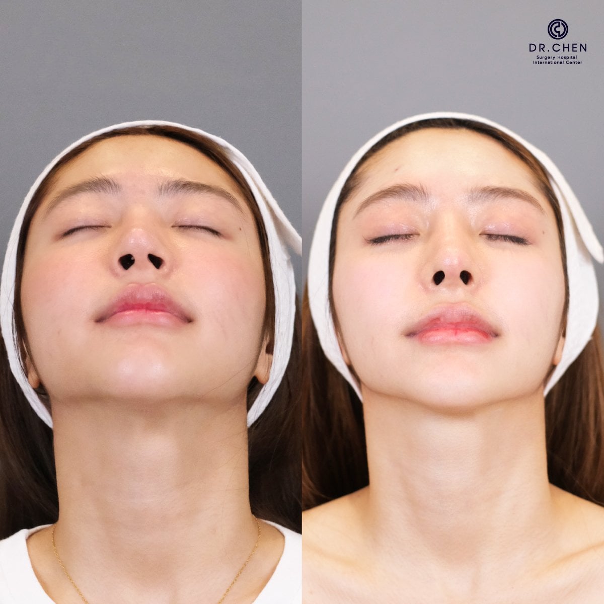 نتيجة قبل وبعد عملية تجميل الأنف التصحيحية في Dr. Chen Surgery Hospital International Center