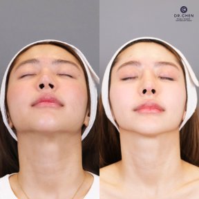 Before and after revision rhinoplasty result at Dr. Chen Surgery Hospital International Center