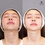 Before and after revision rhinoplasty result at Dr. Chen Surgery Hospital International Center