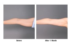 Before and after arm liposuction results at Dr. Chen Surgery Hospital International Center