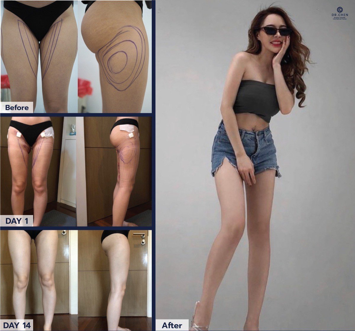 نتائج شفط دهون الفخذين قبل وبعد في Dr. Chen Surgery Hospital International Center