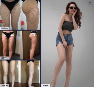 Before and after thigh liposuction results at Dr. Chen Surgery Hospital International Center