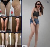 Before and after thigh liposuction results at Dr. Chen Surgery Hospital International Center