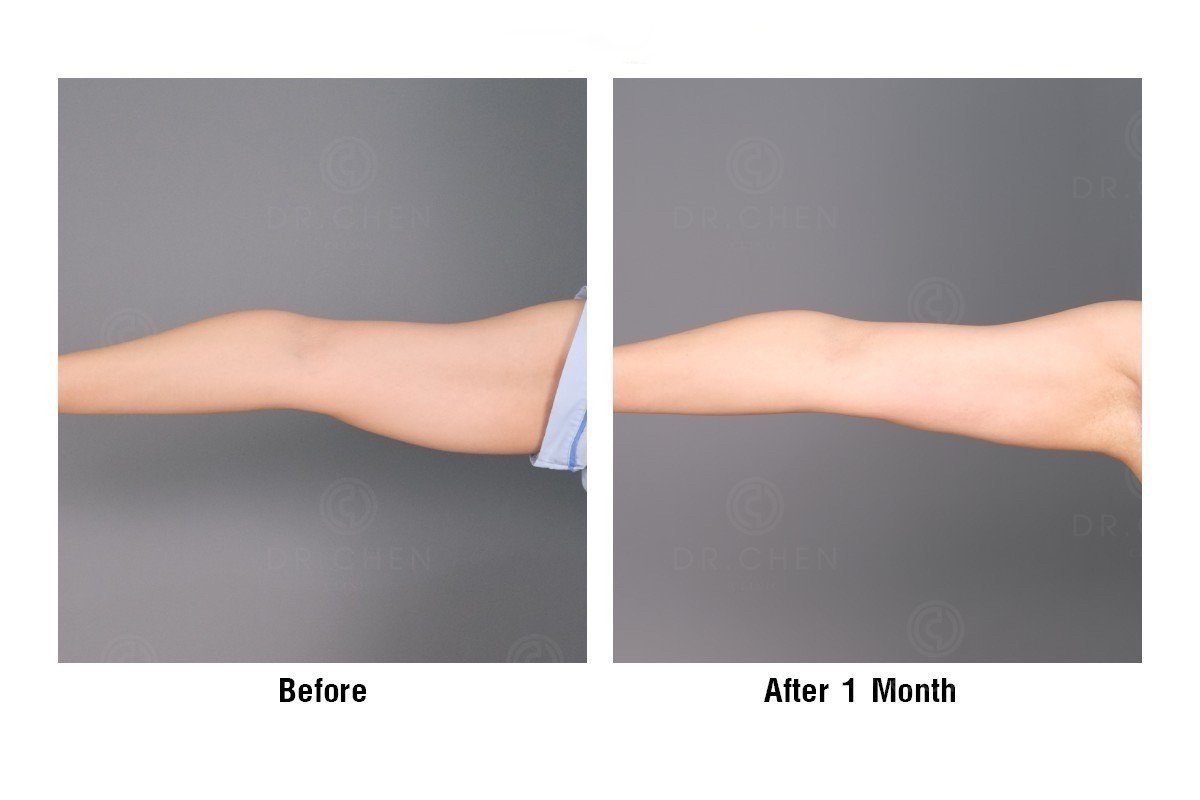 Resultados de liposucción de brazo antes y después en Dr. Chen Surgery Hospital International Center