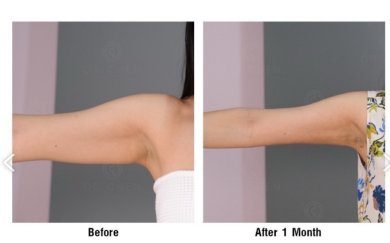 Before and after upper arm liposuction result at Dr. Chen Surgery Hospital International Center