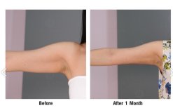 Before and after upper arm liposuction result at Dr. Chen Surgery Hospital International Center