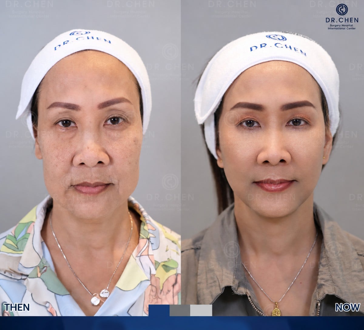 نتيجة حقن الدهون في الوجه قبل وبعد في Dr. Chen Surgery Hospital International Center