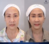 Before and after facial fat transfer result at Dr. Chen Surgery Hospital International Center