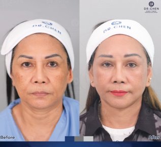 Before and after facial fat transfer at Dr. Chen Surgery Hospital International Center, rejuvenation result