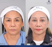 Before and after facial fat transfer at Dr. Chen Surgery Hospital International Center, rejuvenation result