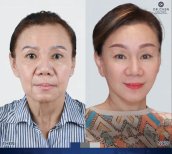 Facial fat transfer before and after results at Dr. Chen Surgery Hospital International Center