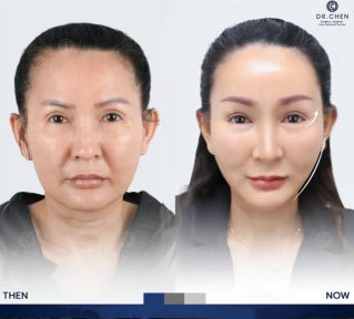Facelift before and after results at Dr. Chen Surgery Hospital International Center, facial rejuvenation