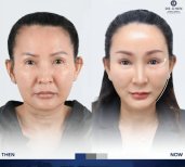 Facelift before and after results at Dr. Chen Surgery Hospital International Center, facial rejuvenation