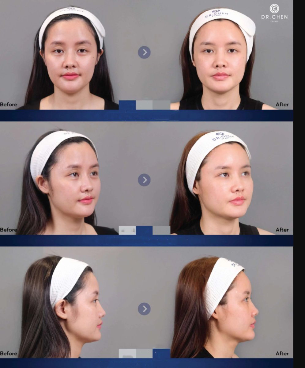 نتيجة قبل وبعد حقن الفيلر في Dr. Chen Surgery Hospital International Center، تحديد الوجه