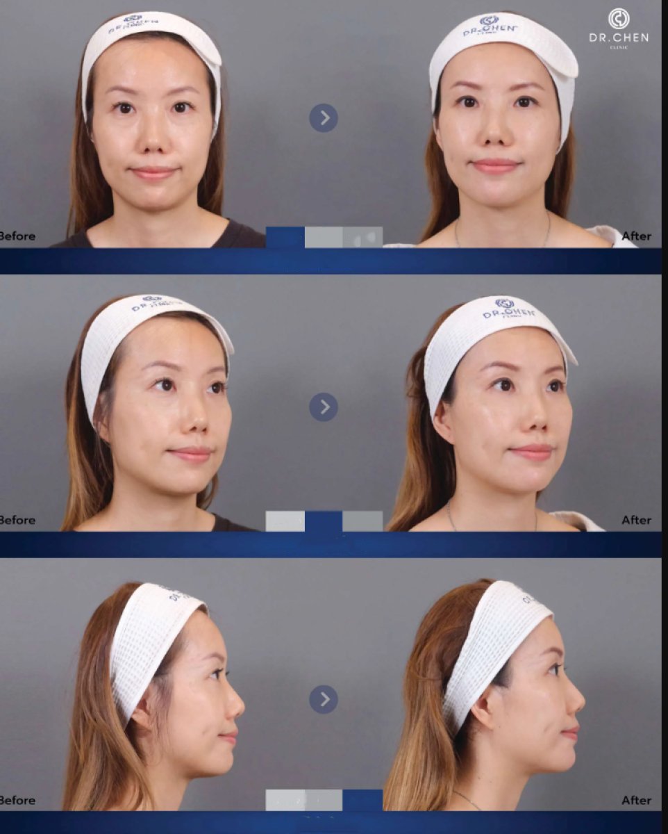 نتيجة قبل وبعد حقن الفيلر في Dr. Chen Surgery Hospital International Center، تحديد الوجه