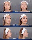 Before and after fillers injection result at Dr. Chen Surgery Hospital International Center, face contour