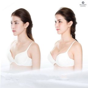 Before and after breast augmentation results at Dr. Chen Surgery Hospital International Center