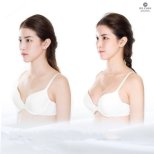 Before and after breast augmentation results at Dr. Chen Surgery Hospital International Center