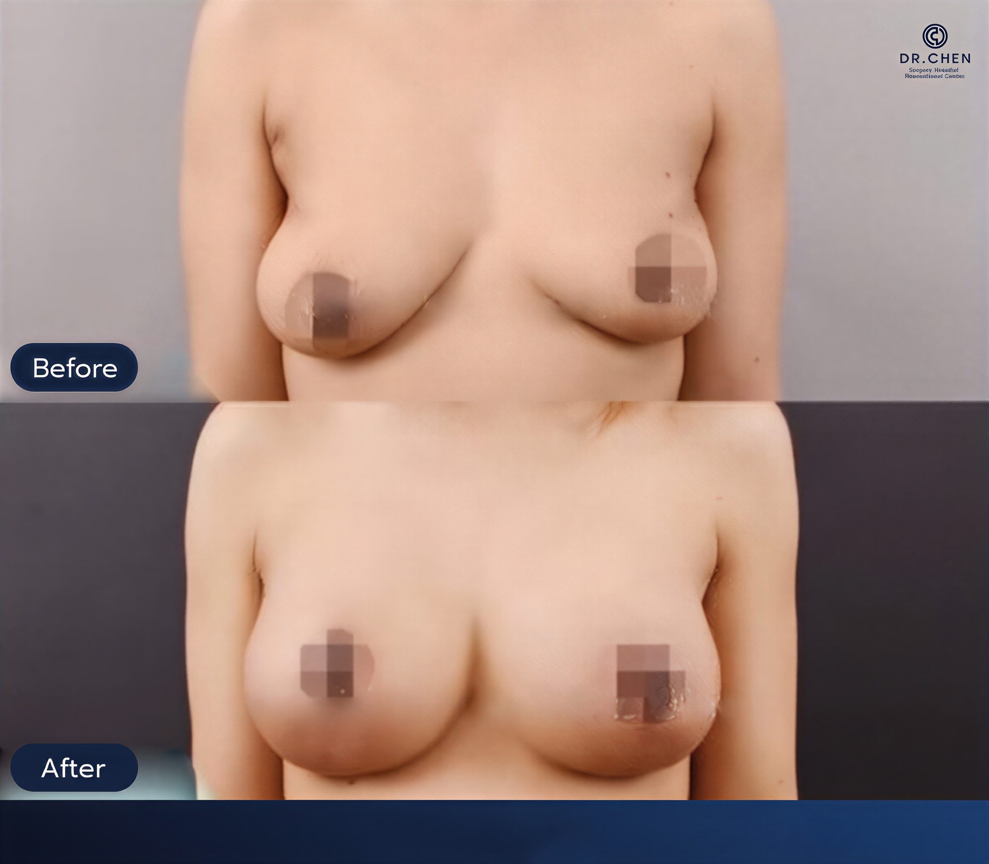 Resultados antes y después de lifting de senos en Dr. Chen Surgery Hospital International Center