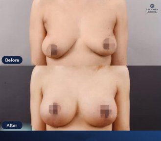 Before and after breast lift results at Dr. Chen Surgery Hospital International Center