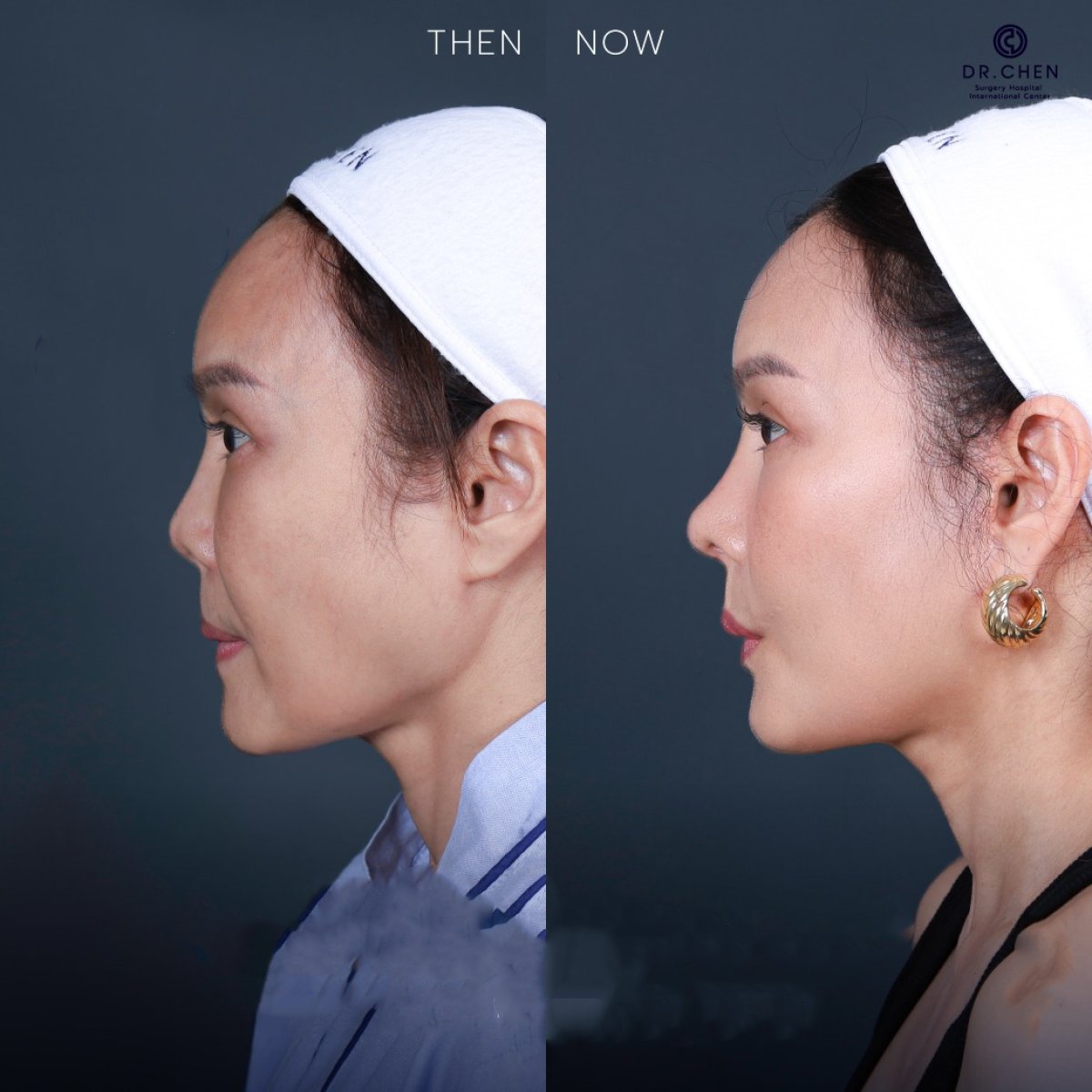 Resultado antes y después de rinoplastia ultrasónica en Dr. Chen Surgery Hospital International Center