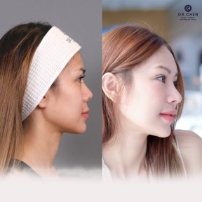 Before and after ultrasonic rhinoplasty result at Dr. Chen Surgery Hospital International Center