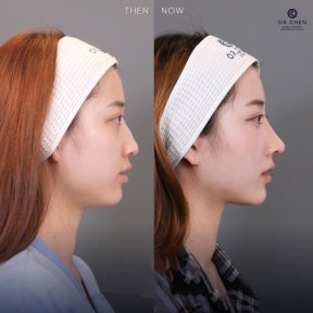 Before and after ultrasonic rhinoplasty result at Dr. Chen Surgery Hospital International Center