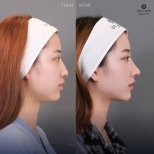 Before and after ultrasonic rhinoplasty result at Dr. Chen Surgery Hospital International Center