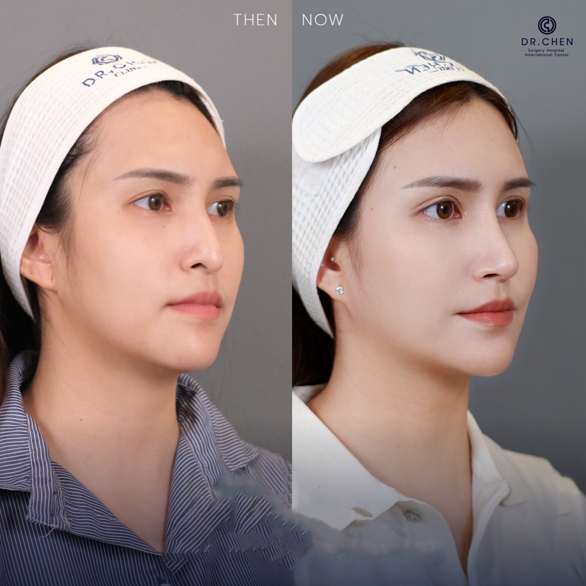 نتيجة قبل وبعد تجميل الأنف بالموجات فوق الصوتية في Dr. Chen Surgery Hospital International Center