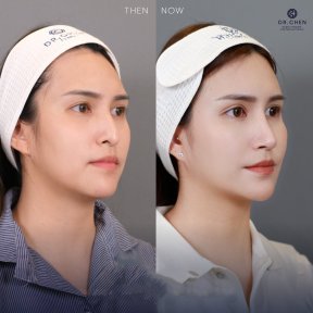 Before and after ultrasonic rhinoplasty result at Dr. Chen Surgery Hospital International Center