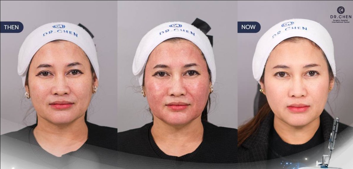 نتائج قبل وبعد إعادة تسطيح الجلد بالليزر في Dr. Chen Surgery Hospital International Center