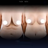 Before and after breast lift results at Dr. Chen Surgery Hospital International Center