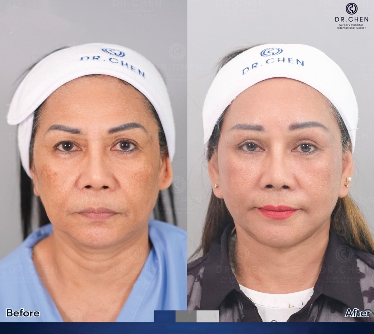 نتائج شد الرقبة قبل وبعد في Dr. Chen Surgery Hospital International Center، تجديد الشباب