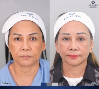 Before and after neck lift results at Dr. Chen Surgery Hospital International Center, rejuvenation