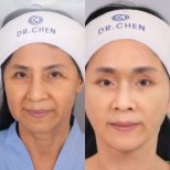 Before and after neck lift results at Dr. Chen Surgery Hospital International Center, rejuvenation