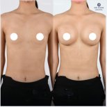 Before and after breast augmentation results at Dr. Chen Surgery Hospital International Center