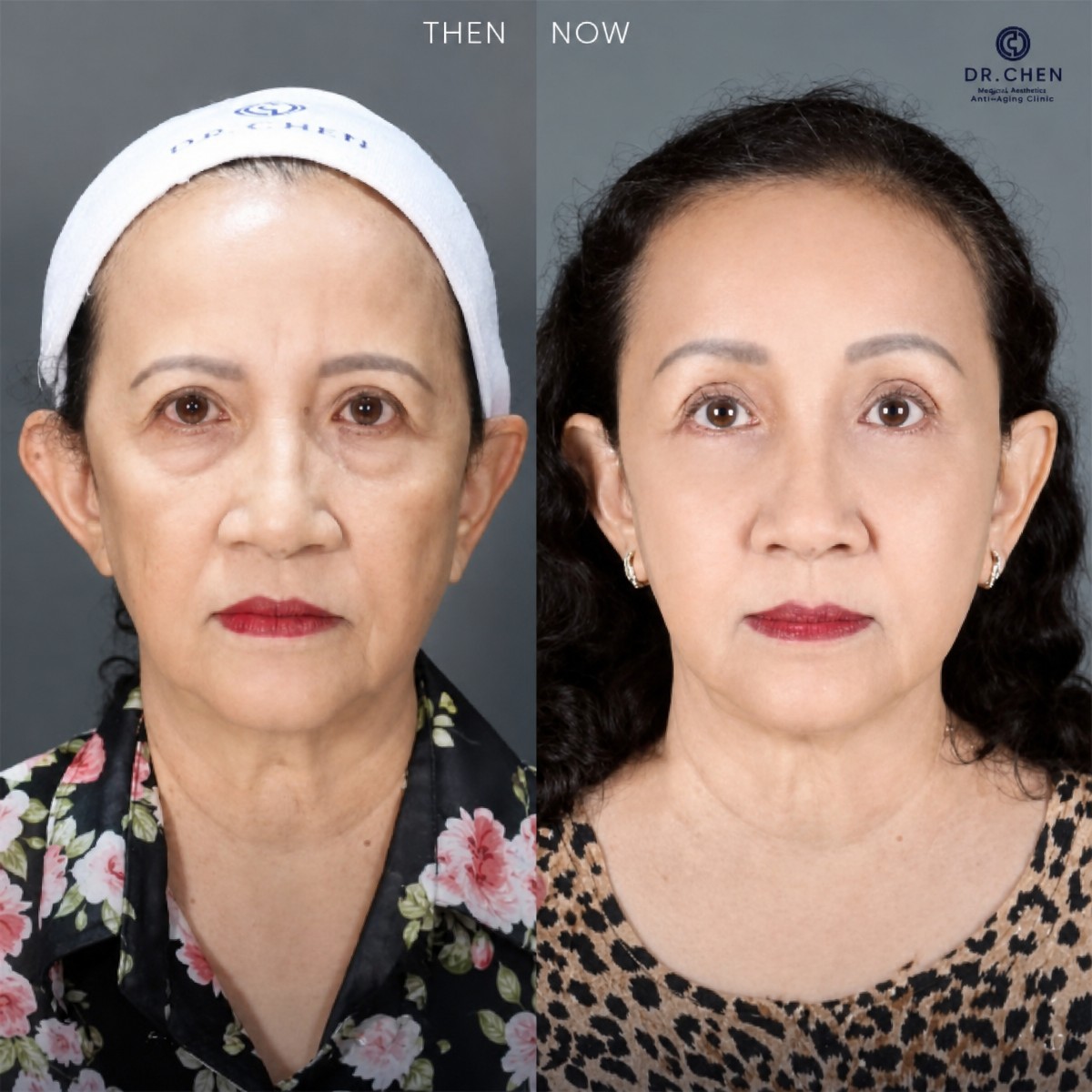نتائج شد الجفن السفلي قبل وبعد في Dr. Chen Surgery Hospital International Center