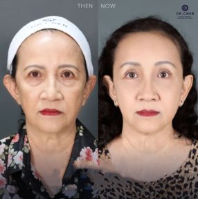 Before and after lower eyelid blepharoplasty results at Dr. Chen Surgery Hospital International Center