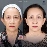 Before and after lower eyelid blepharoplasty results at Dr. Chen Surgery Hospital International Center