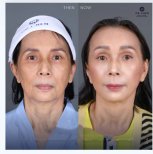 Before and after facial fat transfer results at Dr. Chen Surgery Hospital International Center