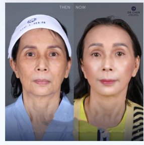 Before and after lower eyelid blepharoplasty results at Dr. Chen Surgery Hospital International Center