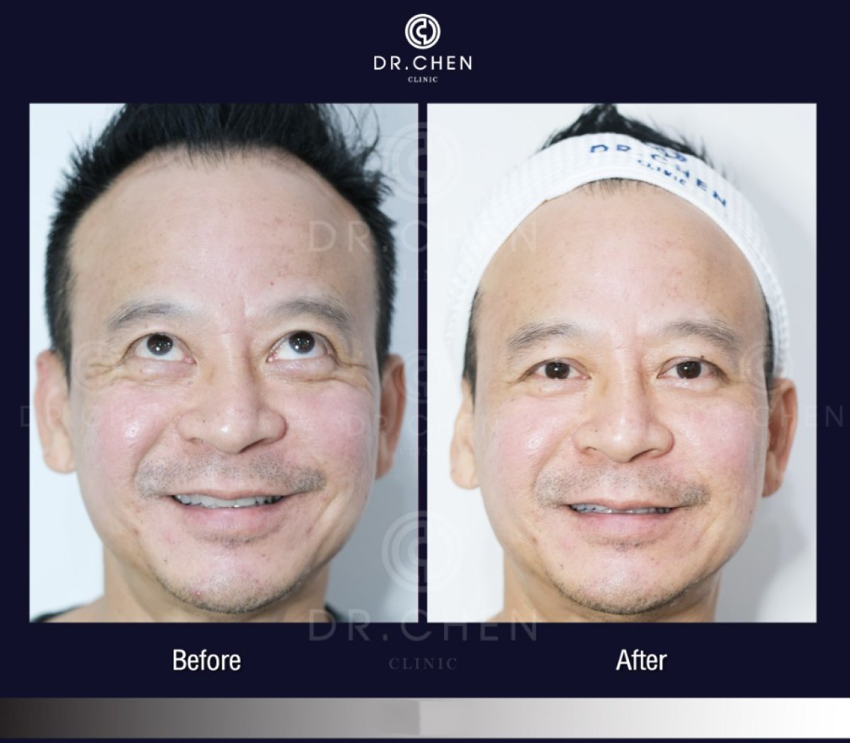Antes y después de inyecciones de bótox en Dr. Chen Clinic, reducción de arrugas en la frente