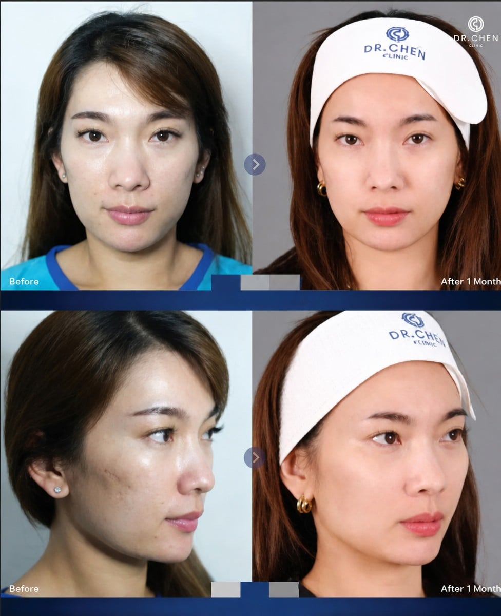 Resultados antes y después de Skinbooster en Dr. Chen Clinic, mejora de la textura de la piel