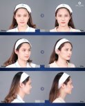 نتائج تجميل الأنف قبل وبعد في عيادة د. تشين، إعادة تشكيل الأنف بمظهر طبيعي