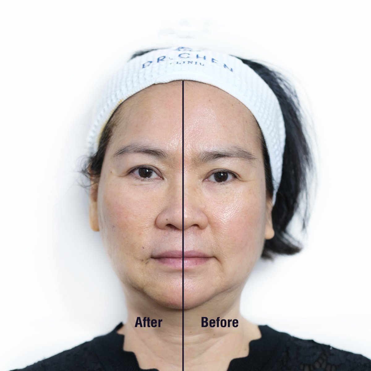 Resultado antes y después de lifting con hilos de ácido hialurónico en Dr. Chen Clinic, rejuvenecimiento facial