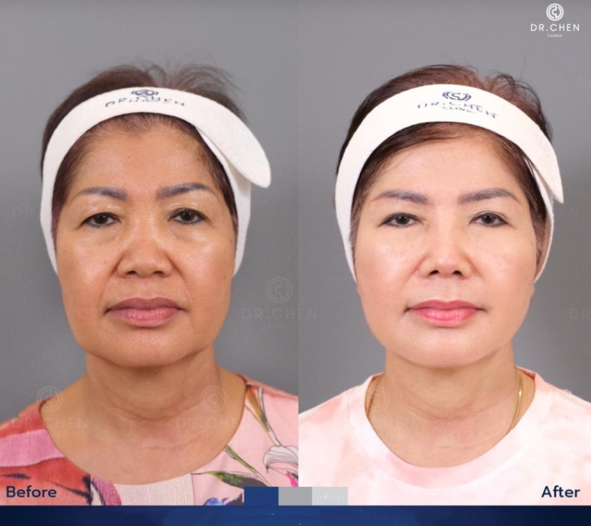 نتائج قبل وبعد علاج Skinbooster في عيادة Dr. Chen، تجديد شباب الوجه