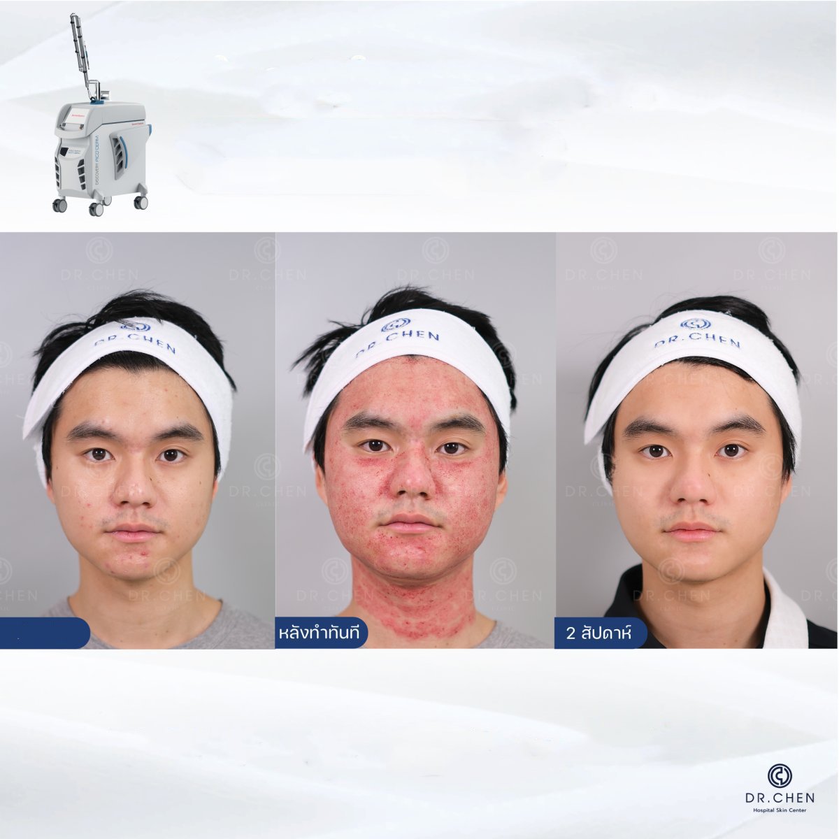 Resultados de rejuvenecimiento facial con láser antes y después en Dr. Chen Clinic, piel mejorada