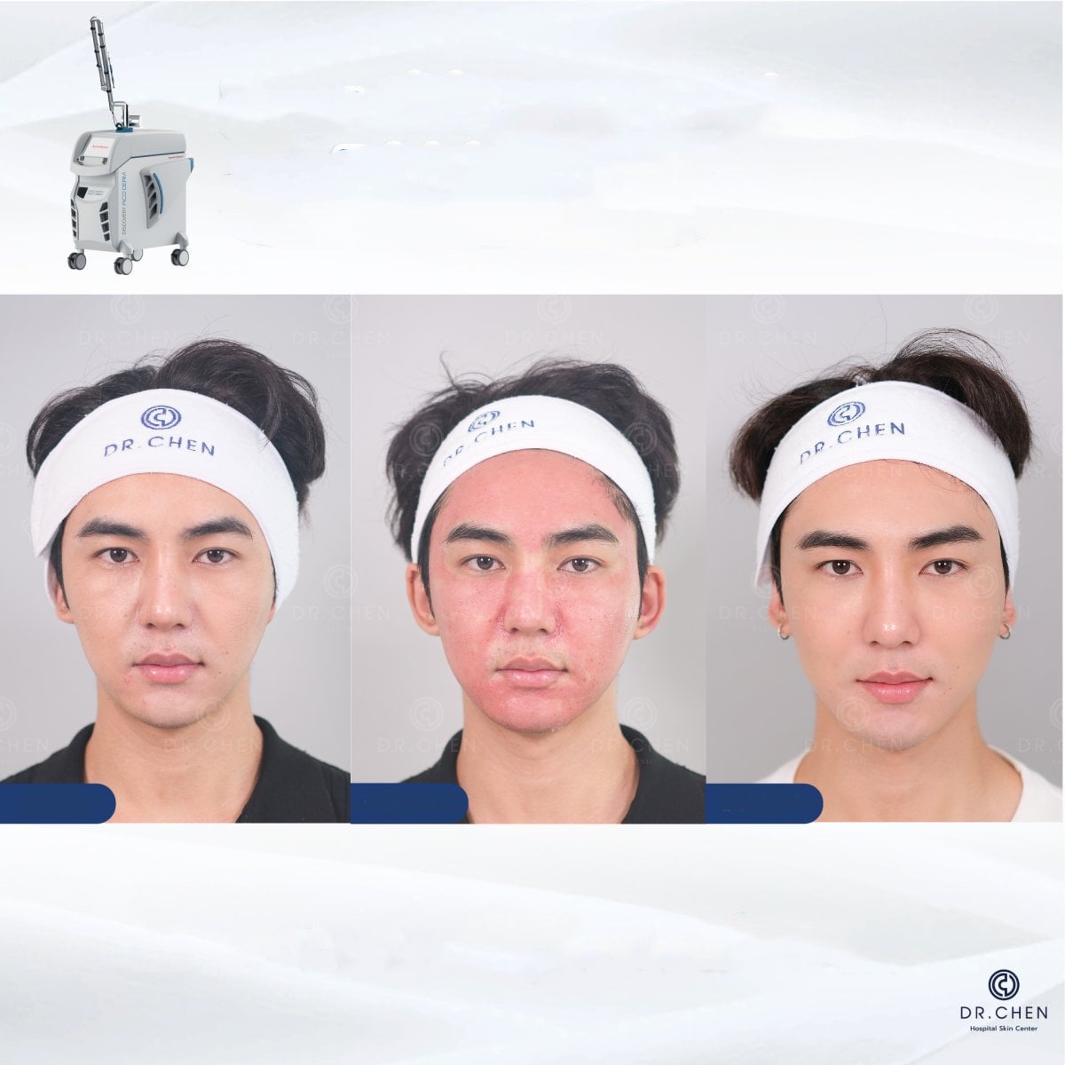 Resultados de rejuvenecimiento facial con láser antes y después en Dr. Chen Clinic, piel mejorada