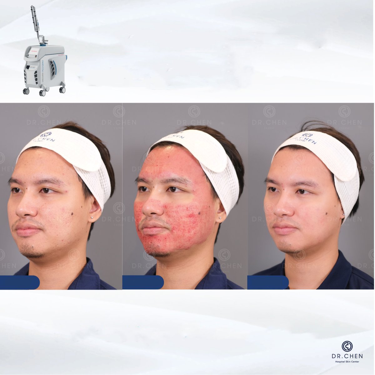 Resultados de resurfacing láser en Dr. Chen Clinic: mejora de textura y claridad facial