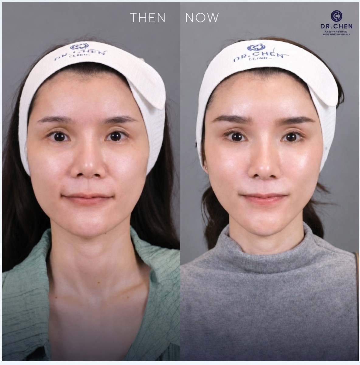 نتائج قبل وبعد علاج Ultherapy في عيادة Dr. Chen – شد واضح لبشرة الوجه